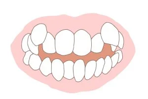 ガタガタの歯（叢生）