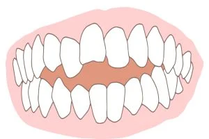 前歯が噛み合わない